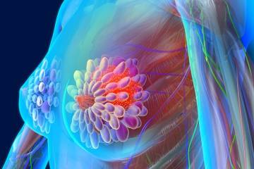 Ung thư vú ở phụ nữ